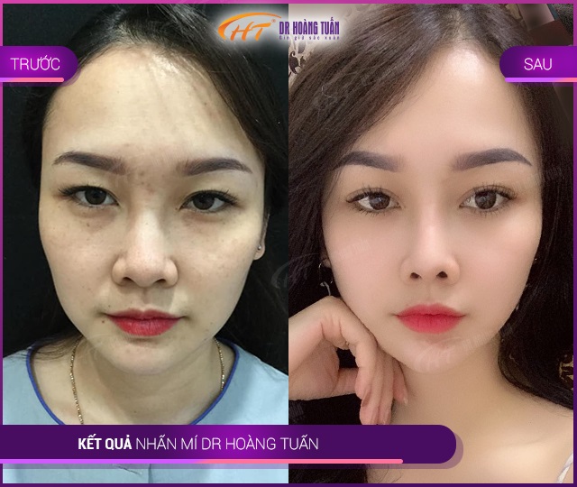 Kết quả bấm mí tại Thẩm mỹ Hoàng Tuấn